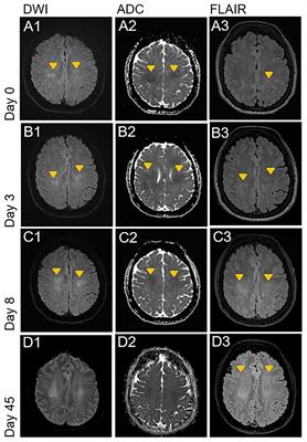 Acute leukoencephalopathy associated with daratumumab treatment in POEMS syndrome: a case report